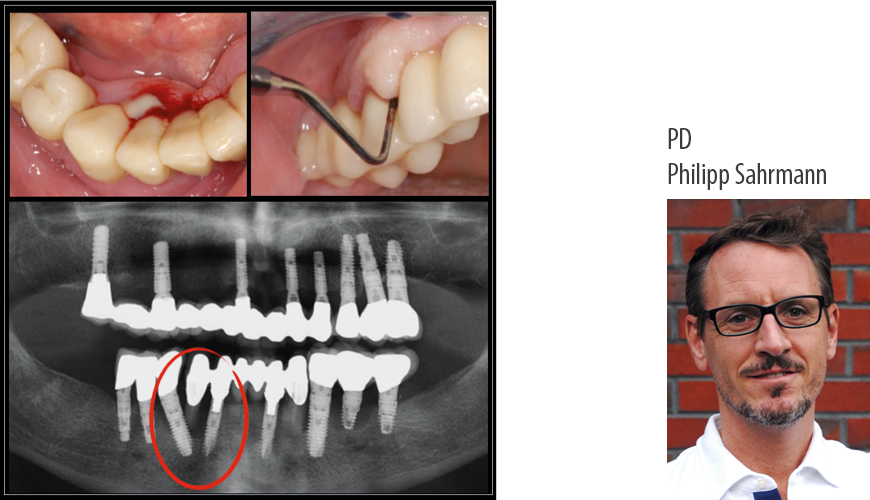 <span>Online-Seminare</span>PD Dr. Philipp Sahrmann:<br>Patienten mit Parodontitis und Peri-Implantitis erfolgreich behandeln