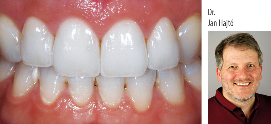 Dr. Jan Hajtó: Functional and Esthetic Anterior Laminate Veneers - Theory and Clinical Application - Kurs: 9817