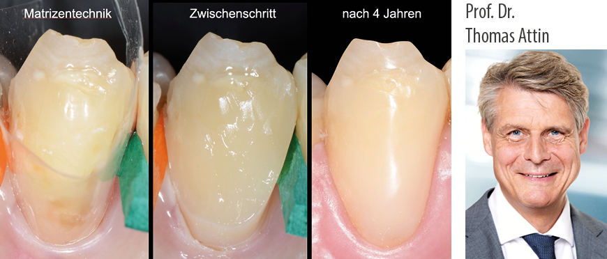Prof. Dr. Thomas Attin: Zahnhalsläsionen – Praxiserprobte Tipps & Tricks zur Versorgung und Prävention - Kurs: 9846
