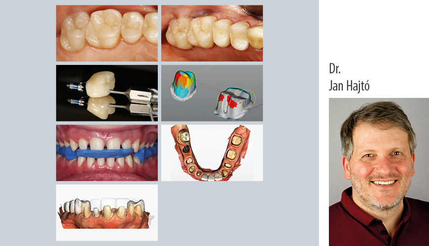 Dr. Jan Hajtó: Einsteigerkurs: Festsitzende Prothetik auf Zähnen und Implantaten